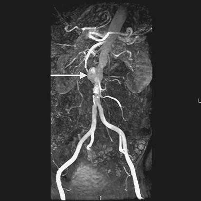 clinical problem-solving cur and involve the infrarenal aorta.