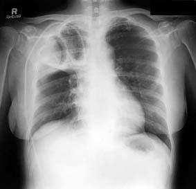 2. Pulmonary parenchymal diseases Infections: especially tuberculosis, pneumonia, aspergilloma, and lung abscess Hemoptysis, which can be