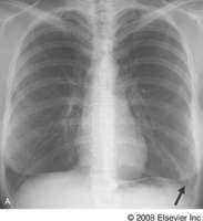 3. Pulmonary vascular disorders Pulmonary embolism (infarction) Pulmonary A-V malformation, either with or without underlying Rendu-Osler-Weber syndrome Elevated pulmonary capillary