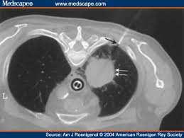 1. Airways diseases - Bronchitis - Bronchiectasis - COPD