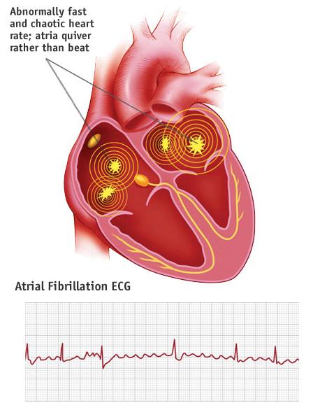 Heart Conduction Disorders (Arrhythmias): Some arrhythmias can cause palpitations (patient can feel heart beat) while many are asymptomatic Some are relatively harmless, some can lead to serious