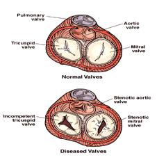 Valvular Disorders: Produce abnormal heart sounds because they reflect defective movement of blood through the valve (heart murmur) Some are harmless, others are severe and need treatment Defective