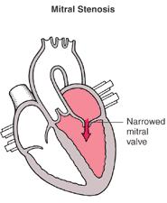 Valvular Disorders: Diagnosis: Cardiac auscultation (heart