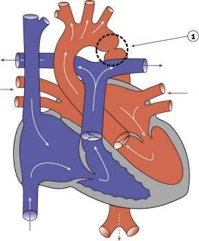 Congenital Heart Disorders: Pathogenesis: Shunting: Blood is diverted from one circulatory system to