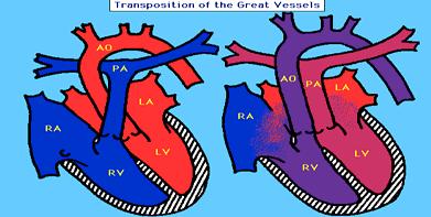 arterial) Severity based on the location of the abnormal openings between the circulatory pathways and