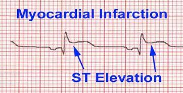 Acute Coronary Syndrome manifestations: Myocardial Infarction: Non-ST elevation