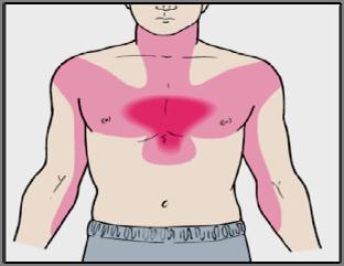 Possible Clinical Manifestations of Myocardial Infarction: Some are silent Sudden, severe chest pain (heavy and crushing), persistent Radiating pain (neck, jaw, back, shoulder, left arm) Indigestion