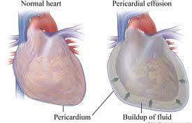 Cardiac Tamponade: a life-threatening compression of the heart due to fluids in the pericardial cavity.