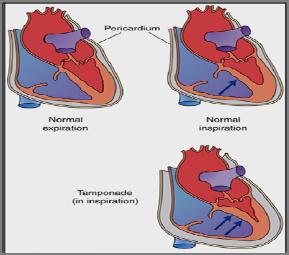 Cardiac Tamponade:.