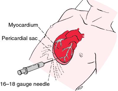 Cardiac Tamponade: Treatment: Anti-inflammatories, pericardiocentesis, surgery Infective Endocarditis: infection of the endocardardium and heart valves Pathogenesis: Vegetative formations develop