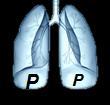 Secretion leakage into the lungs >