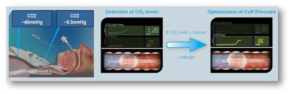 Cuff Pressure Optimization Detects leaks around the ETT cuff based on the CO2 level above the