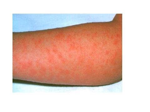 The scarlet fever rash occurs when the streptococcal bacteria release poisons (toxins) that make the skin go red.