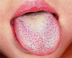 Diagnosing Scarlet Fever The GP can diagnose by examining the rash and asking about any other symptoms ie sore throat.