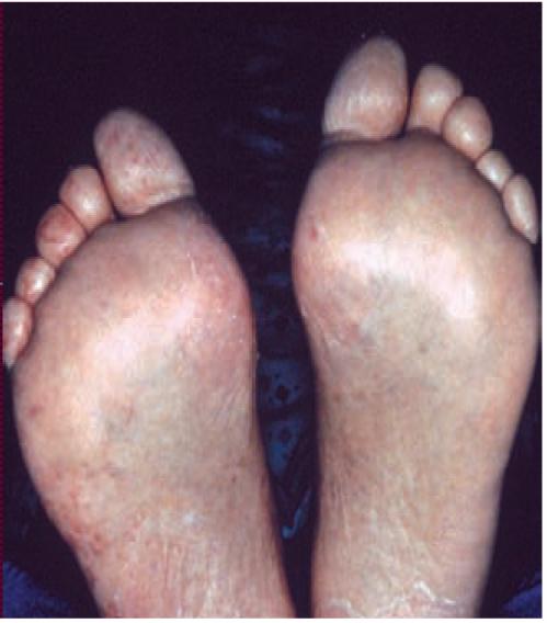 A 57-year-old man presents with new-onset fever, shortness