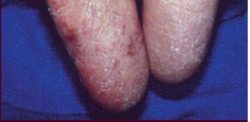 following is a likely abnormality? a. Papilledema b.