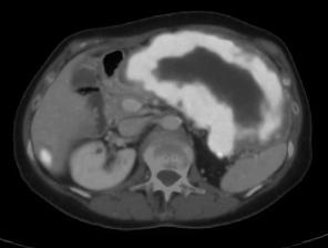 Additional Work-Up PET/CT LUQ mass markedly FDG-avid (SUV 14.7) hypermetabolic lesion in liver not seen on previous CT scan QUESTION #1 What would you recommend as the first step in management? 1. surgical resection 2.