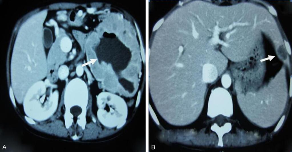 Figure 1. A. Small-bowel GIST with a thickened wall.