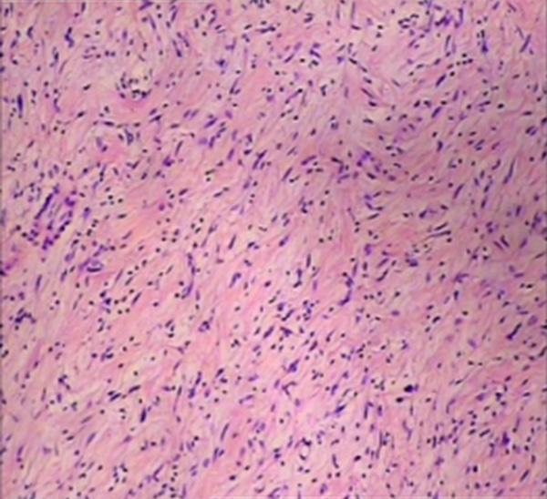 Figure 5. Histologically, the tumor was compsed of interlacing fascicles of uniform spindle cells ( 100). Table 1.