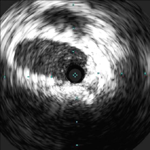 open cell structure IVUS image
