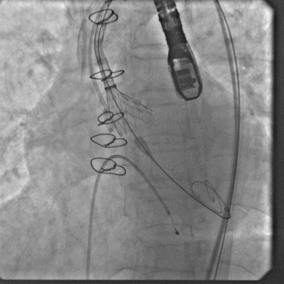 Aortography and check coronary angiography shoots were performed after TAVI to confirm the position of the deployed prosthesis and the coronary artery patency.