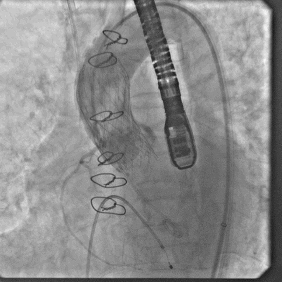 Hemopericardium and aortic dissection are other important complications to be ruled out. Fig. 6 e Core Valve deployment under fluoroscopy and TEE guidance.