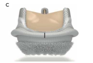 Suturless Aortic valve Intuity (Edwards Lifesciences, Irvine, USA Based on a balloon-expandable stainless steel and cloth-covered frame.