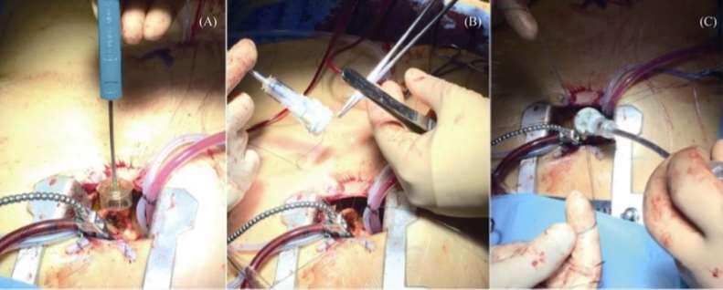 Advantages of SUAVR Over TAVI It does not require crimping of the pericardial leaflet.