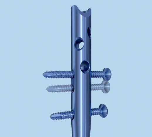 Proximal Locking Compression Locking Mode (Optional) 1 Compression locking mode (optional) If the fracture gap needs compression after nail insertion, it can be accomplished without removing the