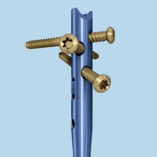 Proximal Locking Proximal Segment Fractures 1 Oblique proximal locking Instruments 03.010.