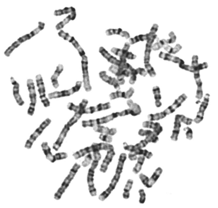 ). Mikrodisekcijom marker kromosoma te reverznim FISH-em potvrđeno je da je mali prekobrojni marker kromosom ssmc(1) duplikacija pruge 1q21 (Slika21d.). Kariotip: mos 47,X,+r(1)(::p21.1->p21.