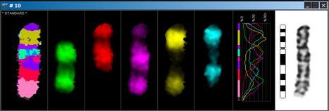 2->pter i segmentalnu monosomiju 1p36.2->pter Kariotip: 46,XY,der(1)t(1;10)(p12.2;p36.2) a d (N) b c Slika 23. (a) Parcijalni kariotip. Kromosom 1, crvena zvjezdica označava der kromosom 1.
