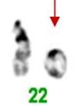 ArrayCGH analizom potvrđena je delecija 22q kromosomske regije, te je precizno utvrđena veličnina delecije od 0,8 Mb i genski sadržaj (Slika 38.