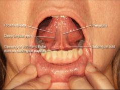 (Median Ridge) Hyoglossus *Hypoglossal (XII) Hyoid Bone Geniohyoid Hyoglossus The hyoglossus