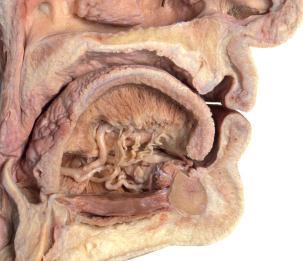 hypoglossal Sublingual Gland Sublingual Gland When saliva is retained or is extravasated