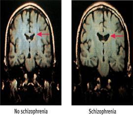Genetic Factors But not all identical twins share a diagnosis of schizophrenia, so