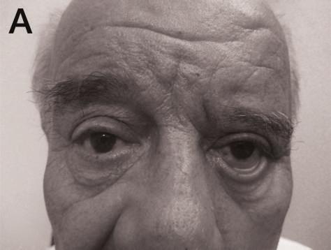 2 Case Reports in Ophthalmological Medicine (a) (b) Figure 1: A 74-year-old man with left facial nerve palsy associated with marked brow ptosis, dermatochalasis, and lower eyelid laxicity (a).