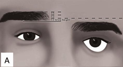 Case Reports in Ophthalmological Medicine 3 (a) (b) (c) (d) (e) Figure 2: Interrupted line extends at the level of 1/3 height of normal brow to the ptotic brow.