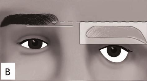By pasting the paper, the brow shape is copied above the ptotic brow(c). Excise. Excision of the outlined area (d). Stitch. Direct and layered closure (e).