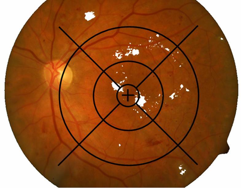 (a) (b) Fig.8.1. Results proposed Fundus Image Analysis System on an Image from DIARETDB1 Database.