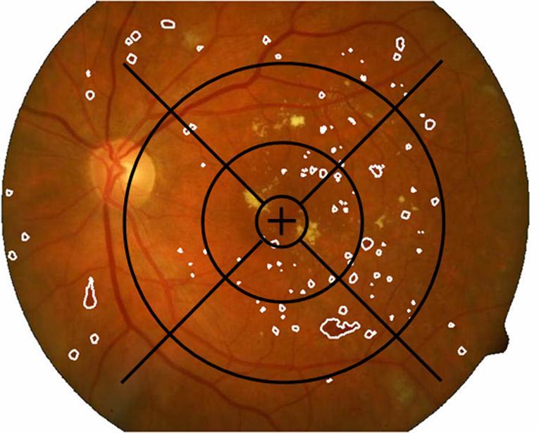 Location of Bright Lesions in Fig. 8.