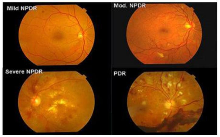 Design and Implementation System to Measure the Impact of Diabetic Retinopathy Using Data Mining Techniques diabetes does not complain from any symptoms.