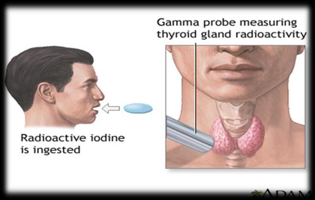 3. Radioactive Iodine Uptake A) Radioactive Iodine Uptake Test; Radioactive iodine uptake test is a type of nuclear test performed to evaluate thyroid function.