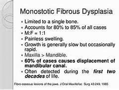 Fibrous dysplasia Monostatic : 1.