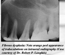 Mandibular lesion occur in molar and