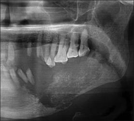 Psammomatoid variant frequently appears outside the jaws, mostly arising in the orbital and frontal bone and