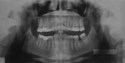 incisors shortened,