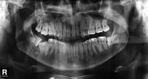 comparison Count teeth Evaluate alveolar and