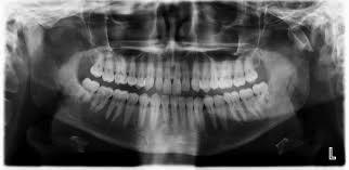 Jawbones Density