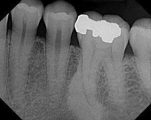 Florid  Radiography: well